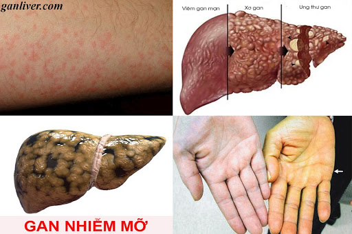 Chức năng gan bị suy giảm do rượu bia như thế nào? Xem ngay kẻo lỡ!